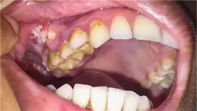 علامات في الفم تدل على سرطان الدم