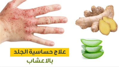 طرق علاج حساسية الجلد بالمنزل